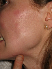 Bed bug bites on a lady's cheek