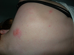 Red spots on shoulders and back